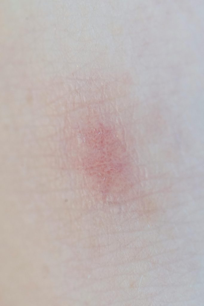 Detailed view of a red skin rash or irritation on human skin.