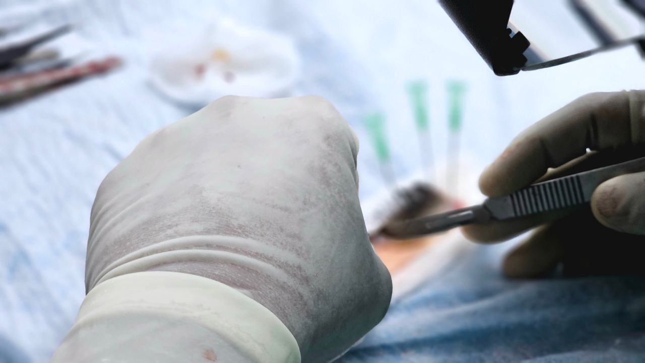 Close-up of a surgical procedure focusing on hair transplant with precision tools.